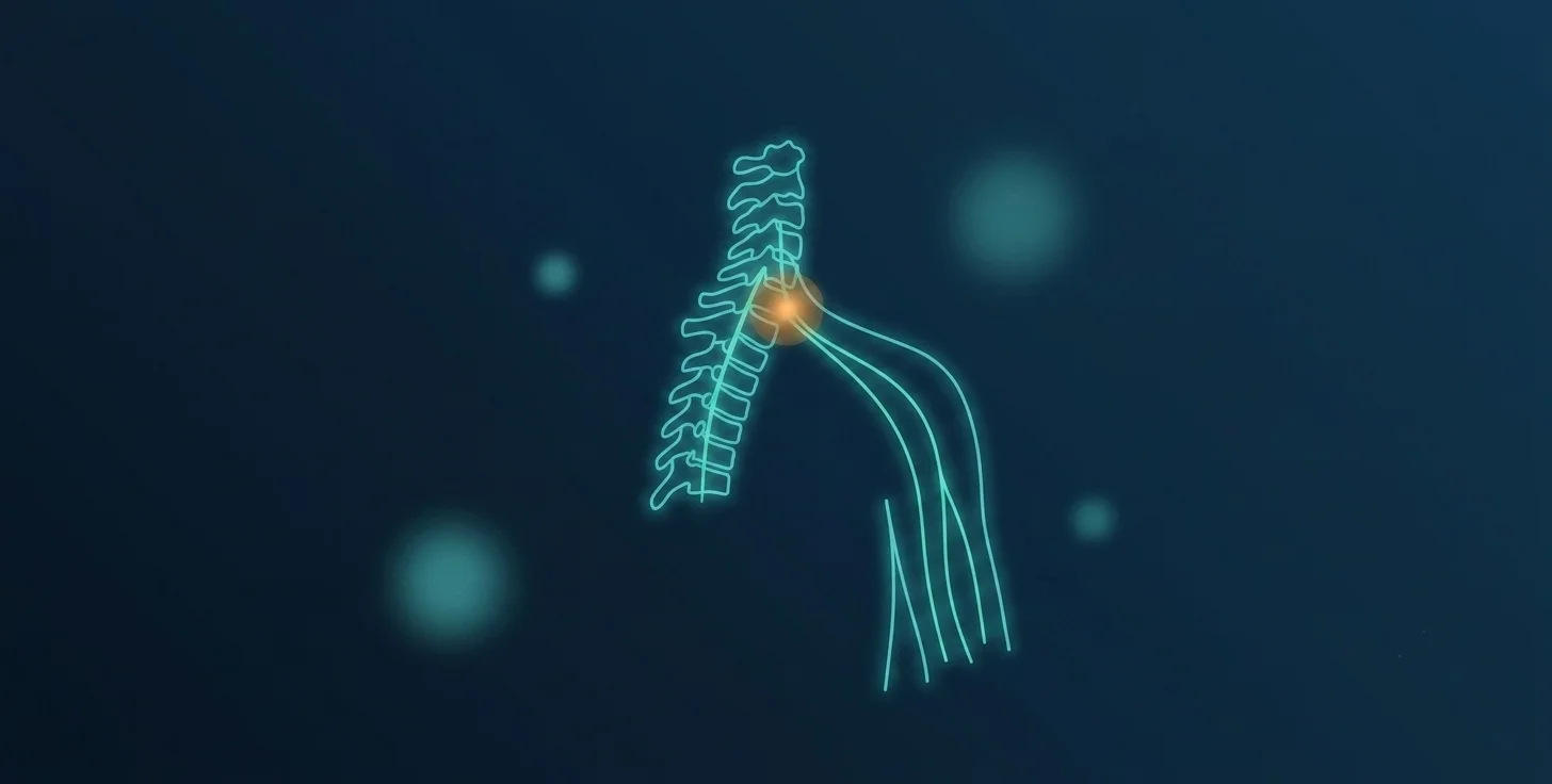 Cervical radiculopathy illustration - neck pain with arm numbness